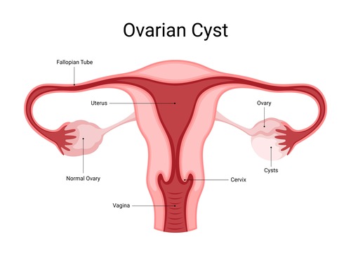 Ovarian Cysts